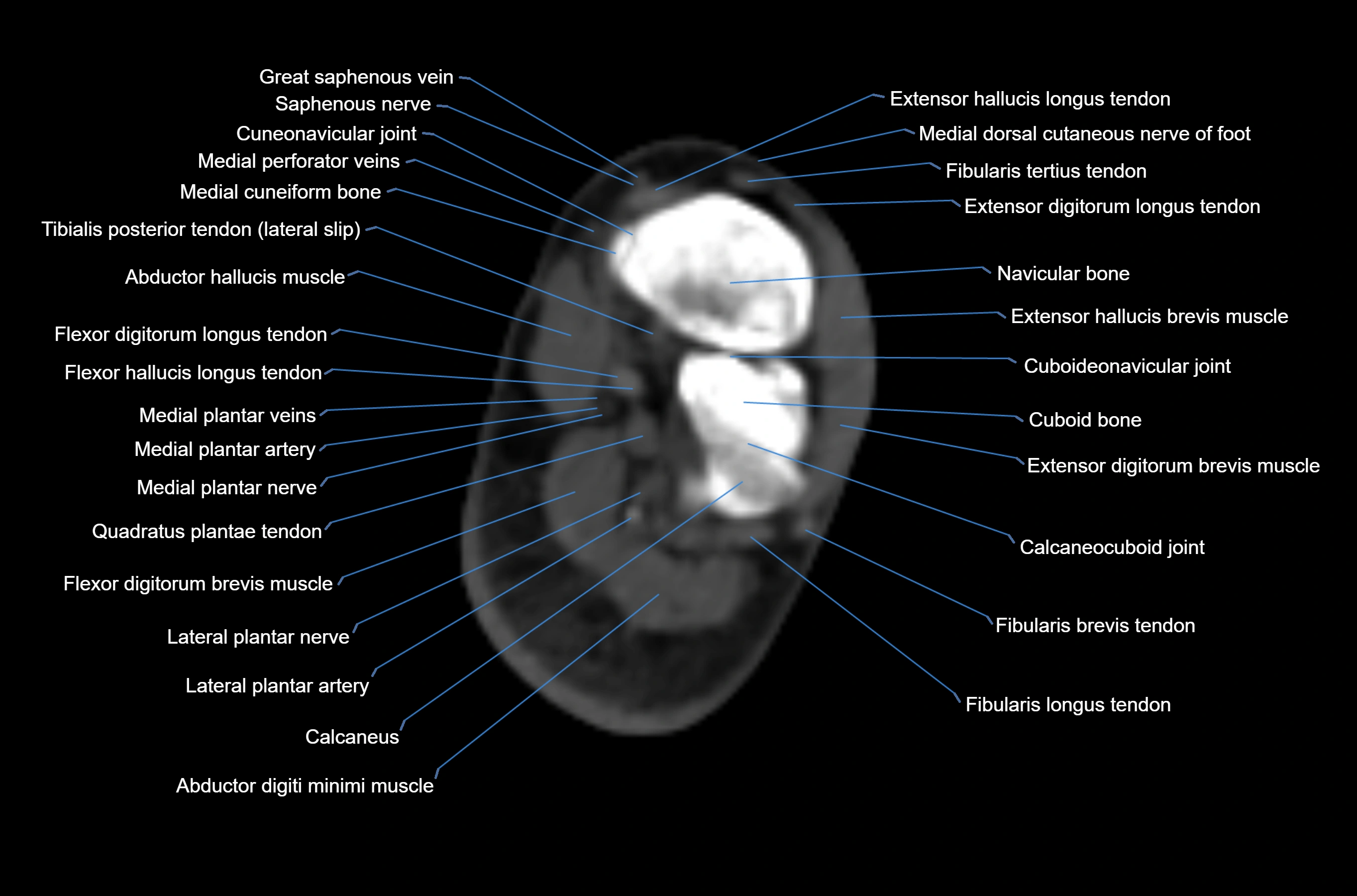 CT Ankle axial cross sectional anatomy labelled image -00047.webp